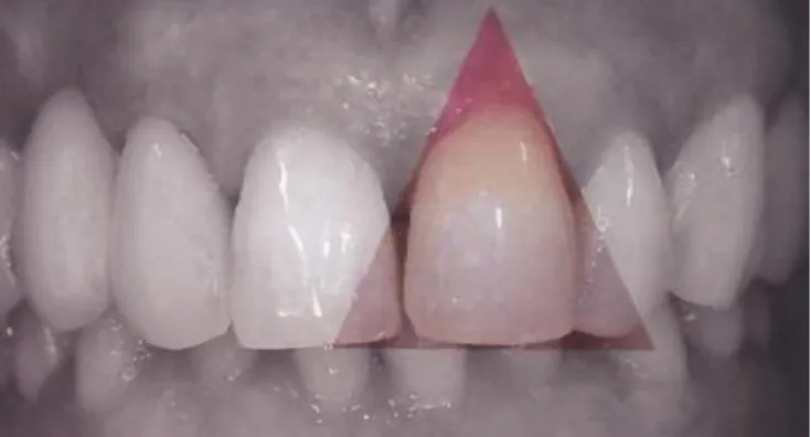 Ilustração  11  –  Dentes  com  forma  triangular. (adaptado de Urzal, 2009)
