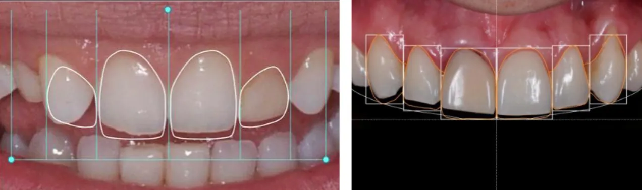 Ilustração 13 – Imagens do programa Digital Smile Design. (adaptado de Coachman)