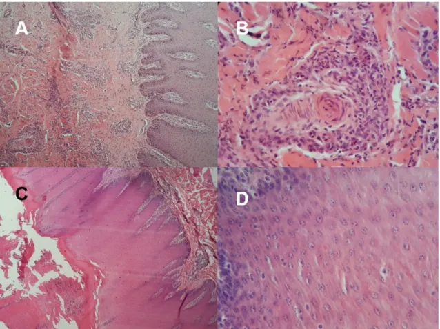 Fig 6. Fotomicrografias de pele ou boca de bovinos afetados por poxviroses. A. Nota-se  infiltrado inflamatório perivascular e superficial multifocal moderado e acantose discreta
