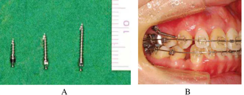 Figura 1. Mini-implantes em ortodontia. A – Mini-implantes. B – O canino superior direito foi distalizado  com uma mola fechada, através do mini-implante