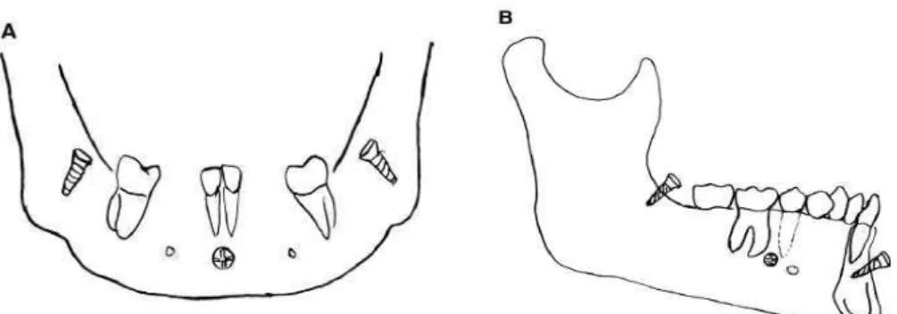Figura 11. Exemplos de possíveis locais para a colocação de mini-implantes. A – Plano frontal