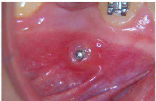 Figura 17. Inflamação do tecido mole em redor do mini-implante colocado na mucosa. (Roncone, 2011) 