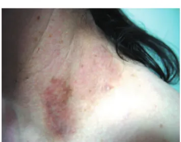 Figure 1 Microvesicules and crusts in the base of the neck.