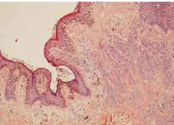 Fig. 4 - Exemplo de melanoma maligno associado a nevo  melanocítico com características histológicas de nevo  con-génito; em que se observam ninhos de melanócitos a rodear  estruturas profundas como vasos e anexos.