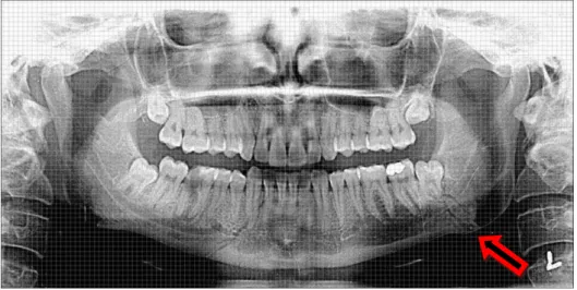 Figura 1: Fratura do ângulo da mandíbula associada a terceiro molar semi-incluso. Adaptado de Yadav et  al