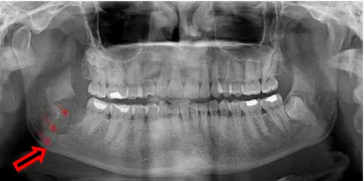 Figura 2: Fratura iatrogénica do ângulo da mandíbula. Adaptado de Cankaya, Erdem, Cakarer, Cifter, and  Oral (2011) 