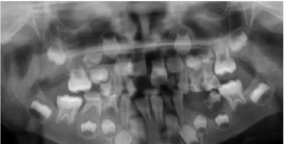 Figura  5.  Ortopantomografia  de  uma  criança  diagnosticada  com  Linfoma  de  Hodgkin  aos  quatro  anos; 