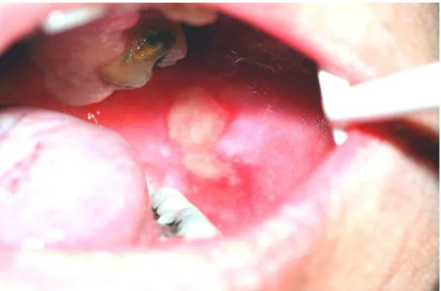 Figura  1  -  Lesão  na  mucosa  oral  causada  por  mucosite  de  um  paciente  que  tinha  recebido  4600  cGy  de  uma  dose  total  prevista  de  6200  cGy,  sem  quimioterapia  concomitante,  para  tratamento  do  carcinoma  de  células  escamosas  da