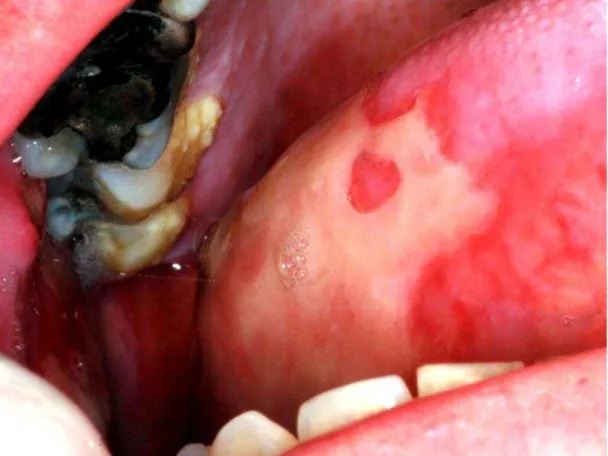 Figura  2  -  Úlcera  causada  por  mucosite  situada  na  lingual  no  mesmo  paciente  que  a  Figura 1 (Fonte: Lalla, R