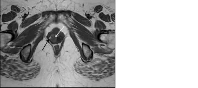 Figure 2 Sagittal T2-weighted image