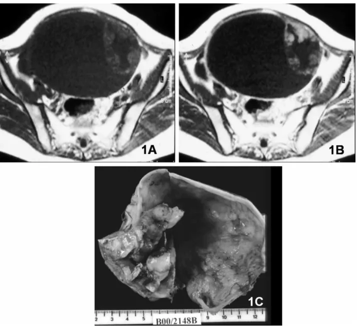 Fig. 1. Clear-cell carcinoma. A. Large cystic right adnexal lesion with intermediate-signal-intensity solid papillary projections and a thick septum on axial T1-weighted MR image