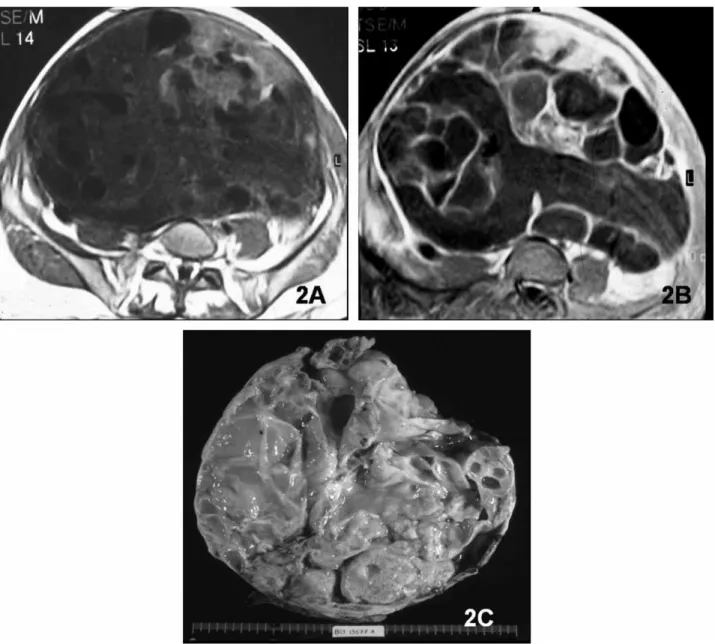 Fig. 2. Mucinous borderline tumor. A. Large multiloculated right adnexal cystic mass shows heterogeneous signal intensity with thick septa on axial T1-weighted MR image