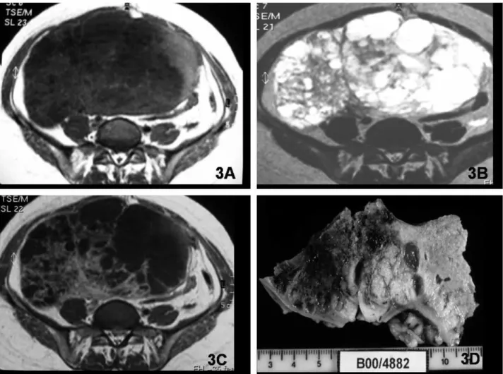Fig. 3. Germ-cell tumor of the right ovary in a 40-year-old woman. Large mixed mass with solid and cystic components on T1-weighted (A) and T2-weighted (B) images