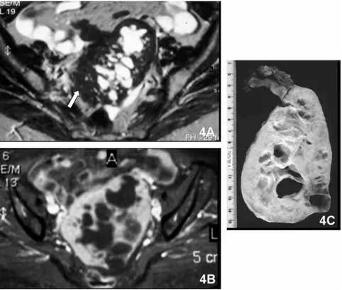 Fig. 4. Left adnexal fibroma in a 70-year-old woman. A. Mixed left adnexal lesion demonstrates heterogeneous signal intensity with high- high-signal-intensity cystic portions and low-high-signal-intensity solid portions (white arrow) on axial T2-weighted M