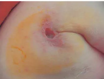 Figure 2. Ulcer in the left axillary fold and nodular lesion on the wrist.