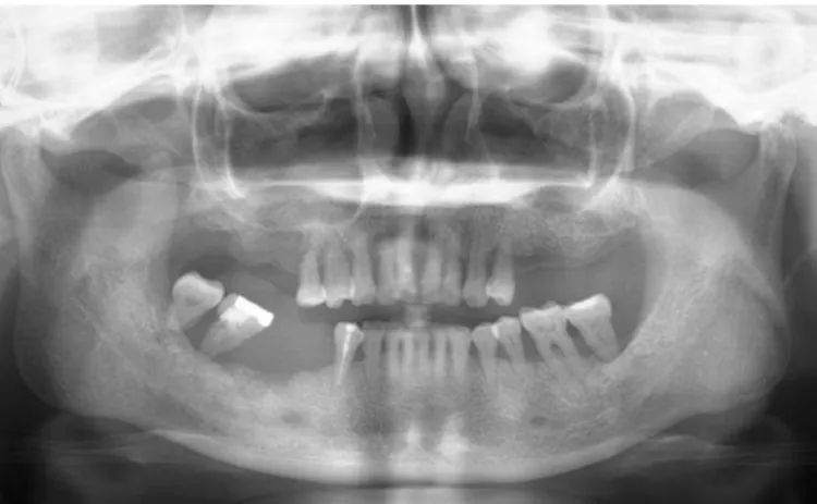 Figura 22 - Ortopantomografia com perda óssea irregular no rebordo alveolar direito da mandíbula  Adaptado de (Goto et al., 2012) 