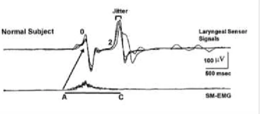 Figura 2 – Figura adaptada de Ertekin et al., 1998. Sinal de eletromiografia da musculatura SH (inferior) e sinal  do  sensor  laríngeo  (acelerómetro)(superior),  recolhido  durante  a  deglutição  de  água,  num  indivíduo  saudável