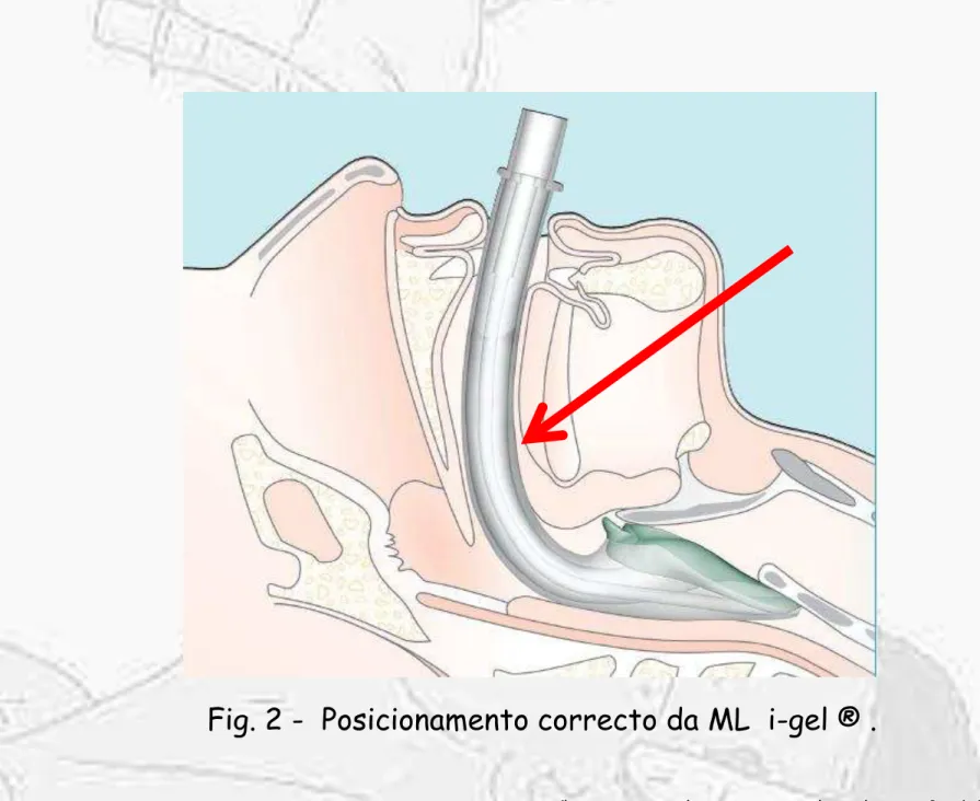 Fig. 2 -  Posicionamento correcto da ML  i-gel ® . 