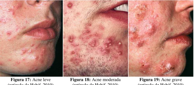 Figura 17: Acne leve 
