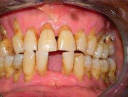 Figura  4  -  Lesões  de  abfração  e  abrasão.  Contactos  prematuros  dos  pré-molares  superiores  com  os  inferiores