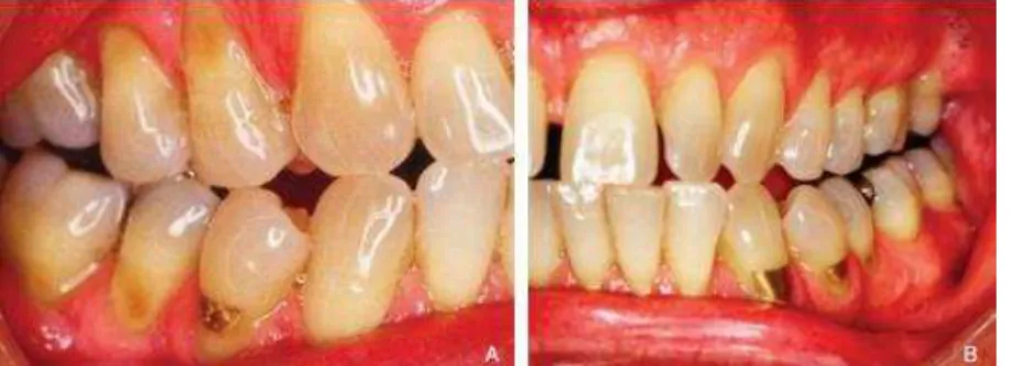 Figura 7 - Lesões dentárias de origem não cariosa ao nível dos pré-molares superiores e inferiores  (abrasão, erosão, abfração)