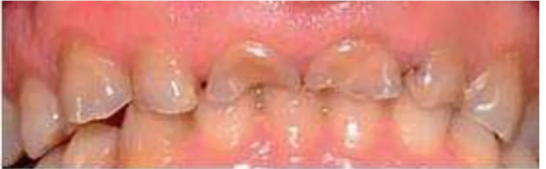 Figura  11  -  Elevado  grau  de  erosão  dentária  nos  4  incisivos  maxilares  de  uma  paciente  de  32  anos  diagnosticada  com  Doença  do  Refluxo  Gastro-esofágico