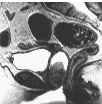 Fig.  8  –  RM,  ponderação T2  em  plano  sagital:  tumor  localizado  nos terços  médio e  inferior da  vagina,  sem sinais  de invasão  local.