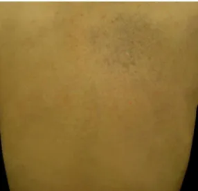 Figure 1 Macular blue – grey hyperpigmentation of the right side of her upper back and shoulder.