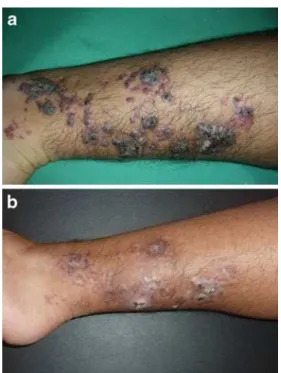 Fig. 1 a Verrucous hemangioma on the lower limb of a 4-year-old girl. b Improvement after sessions with PDL and combined dual  PDL-Nd:YAG laser