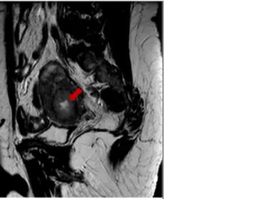 Figure 4 Post-treatment magnetic resonance imaging