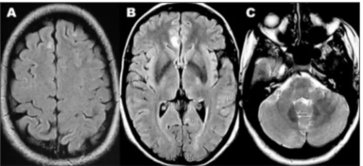 Fig 1. Brain MRI: (A) and (B), axial luid-attenuated inversion recov- recov-ery (FLAIR), show right subcortical frontal (A) and anterior  ipsilat-eral periventricular (B) hyperintense lesions