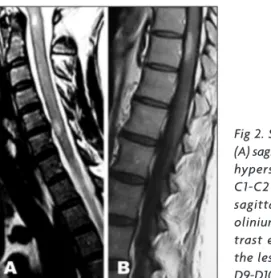 Fig 2. Spinal cord MRI: 
