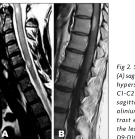 Fig 2. Spinal cord MRI: 