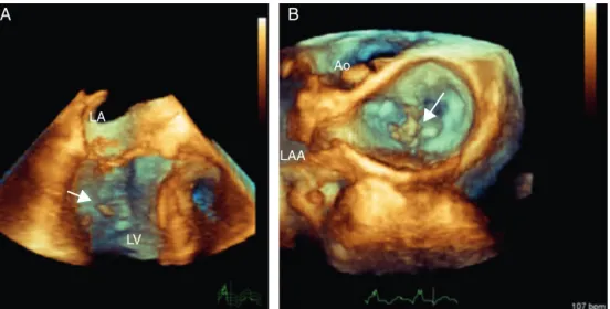 Figure 3 Three-dimensional transesophageal echocardiography. (A) Full volume cropped image showing the detached head of the anterior papillary muscle inside the LV (arrow) causing severe prolapse of the posterior leaflet; (B) 3D Zoom of the mitral valve sh