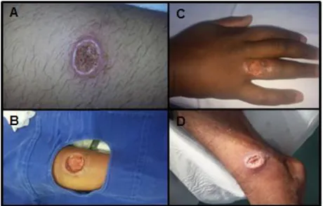 Figura 4: Fotografias de lesões de alguns pacientes da pesquisa. (A)  Lesão de paciente de Corte de Pedra com LCL primária (B) Lesão de  paciente  atendido  no  HUB  com  LCL primária