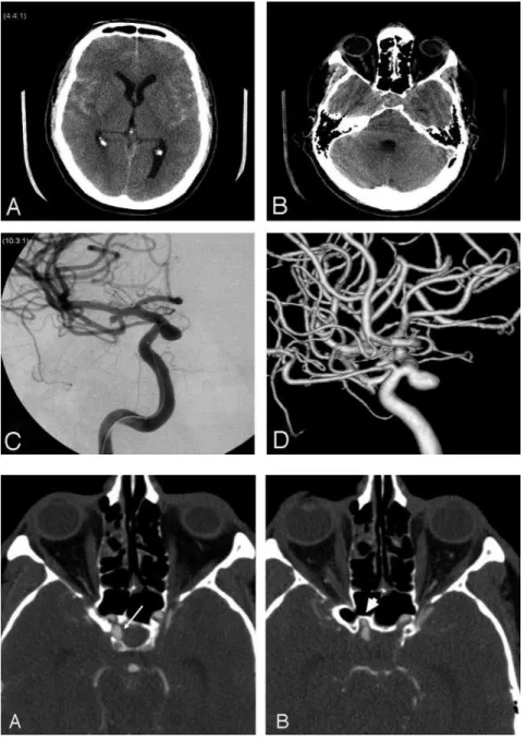 Fig 1. A, Axial unenhanced CT shows diffuse symmetric subarachnoid hemorrhage. B, Questionable hyperattenuation at the level of the sella turcica is difficult to interpret given adjacent streak artifact