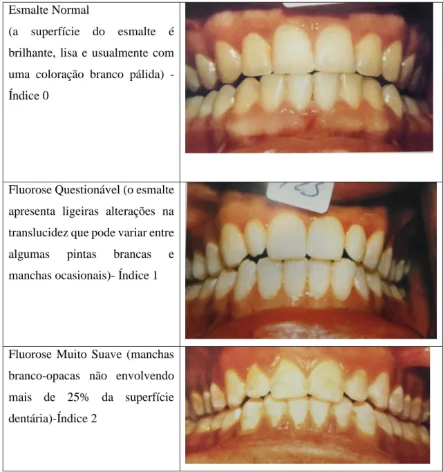 Tabela 1-Índice de Dean (Pereira et al.,2001) 