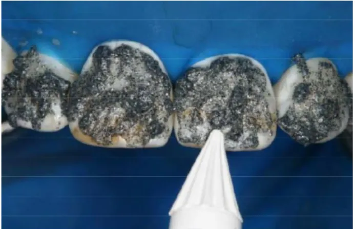 Figura 7-Aplicação da pasta microabrasiva (Domingues et al., 2015)