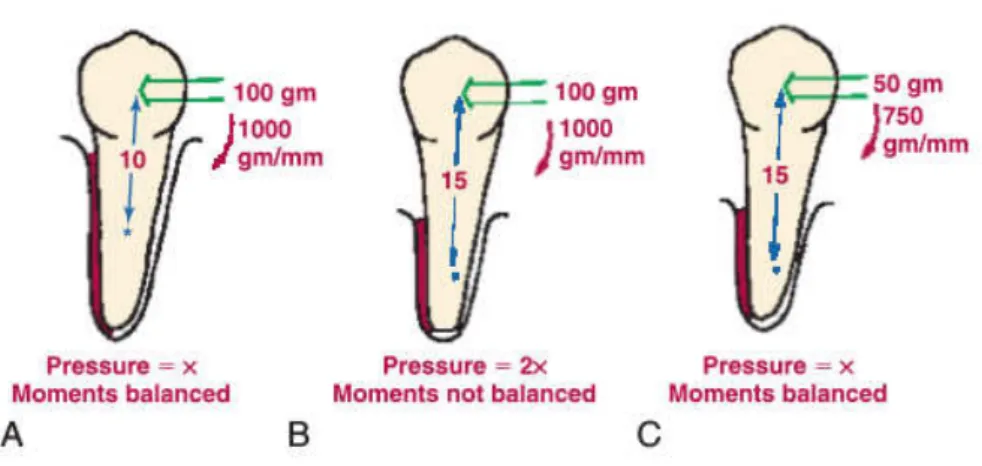 Figura  3  -  A  importância  da  perda  óssea  na  força  e  momento  necessário  a  aplicar  no  movimento  ortodôntico