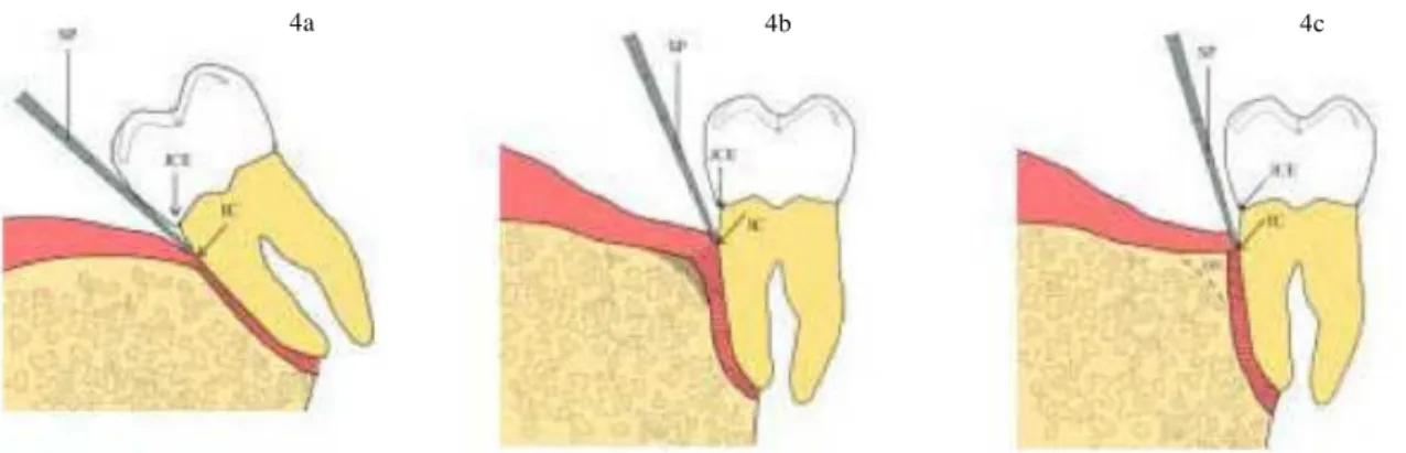 Figura 4 - Movimento de Verticalização Molar. Adaptado de Janson et al. (2001) 