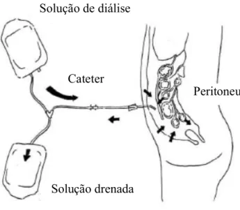 Figura 3. Diagrama do proceso de Diálise Peritoneal (Figura adaptada de Álamo et al., 2011)
