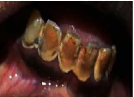 Figura 6. Formação de cálculo dentário (Figura adaptada de Kaushik et al., 2013).