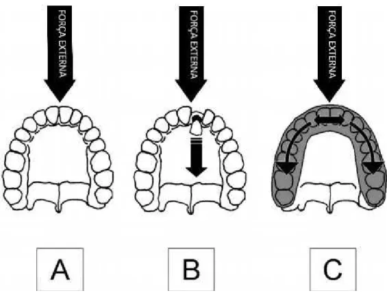 Figura 2: Ilustração da distribuição de forças. A, Força aplicada no dente sem protetor bucal