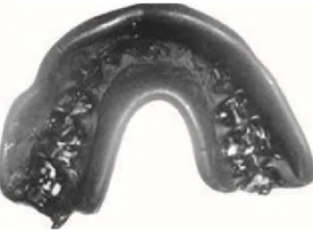 Figura 6: Protetor bucal termo moldável (adaptado de Dhillon et al., 2014). 