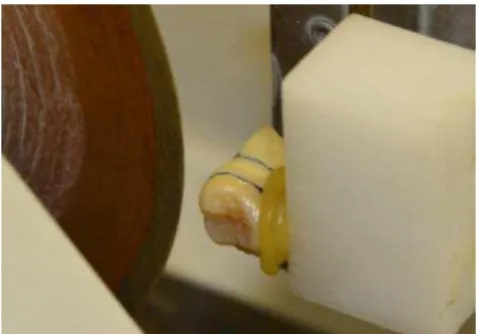 Figura  3  -  Dente  colado  com  cera  colante  no  dispositivo de acrílico