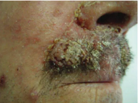 Figure 1: Nodular lesions located on the upper lip.