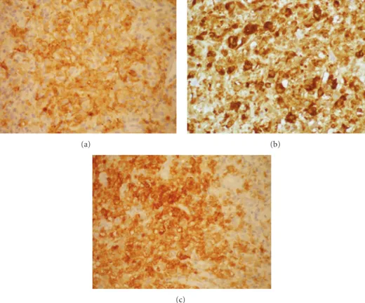 Figure 3: Immunohistochemical examination showed positivity for CD1a (a), CD68 (b), and S100 protein (c).