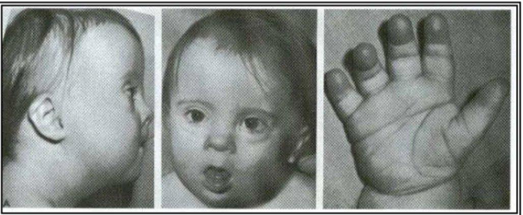 Figura 6 - Criança com Síndrome de Down  e principais características visíveis. (http:www.google.pt) 