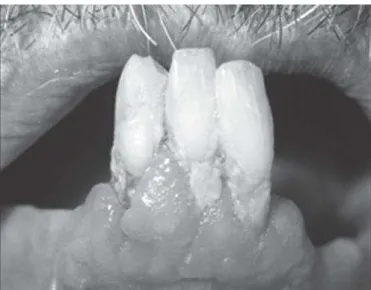 Figura 5. Estado clínico da cavidade oral de um idoso de 92 anos (Haikal et al.,  2009)