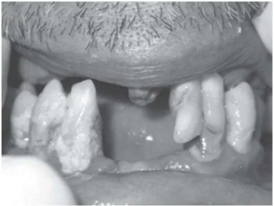 Figura 7. Estado clínico da cavidade oral de um idoso de 62 anos (Haikal et al., 2009)
